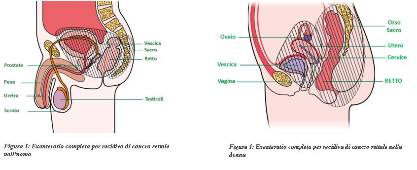 Exenteratio completa per recidiva di cancro rettale nell'uomo e nella donna